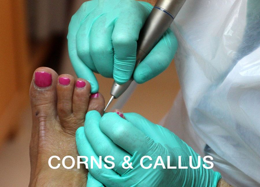 Mobile treatment of corns and callus in Rugby