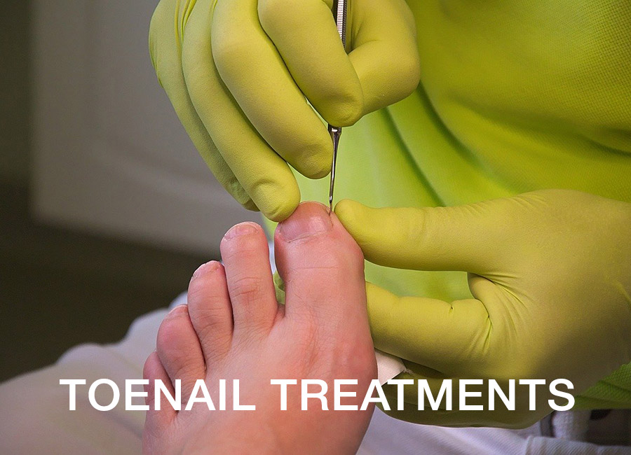 Toenail treatment in Rugby